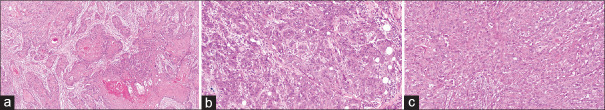 Development of clinico-histopathological predictive model for the assessment of metastatic risk of oral squamous cell carcinoma.