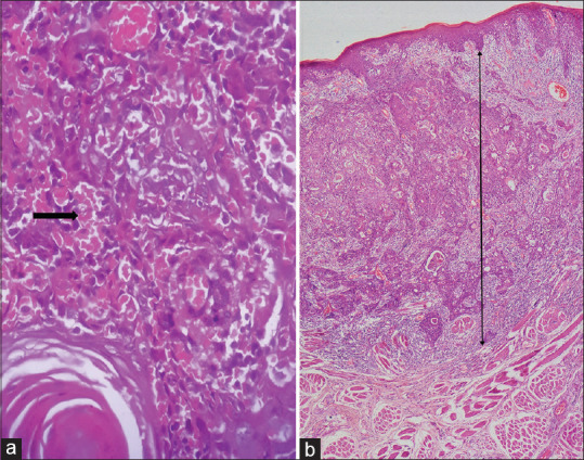 Development of clinico-histopathological predictive model for the assessment of metastatic risk of oral squamous cell carcinoma.