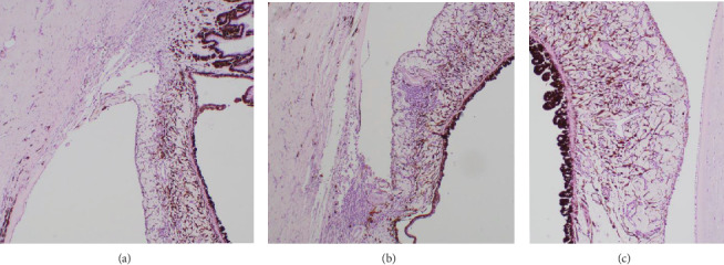 Suspected Spontaneous Aqueous Humor Misdirection Syndrome in a Boston Terrier.