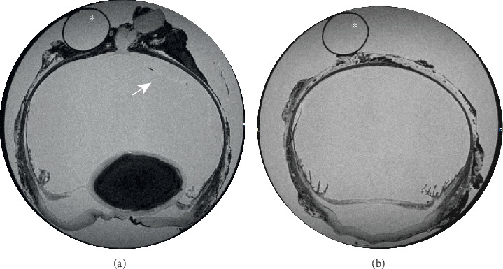 Suspected Spontaneous Aqueous Humor Misdirection Syndrome in a Boston Terrier.