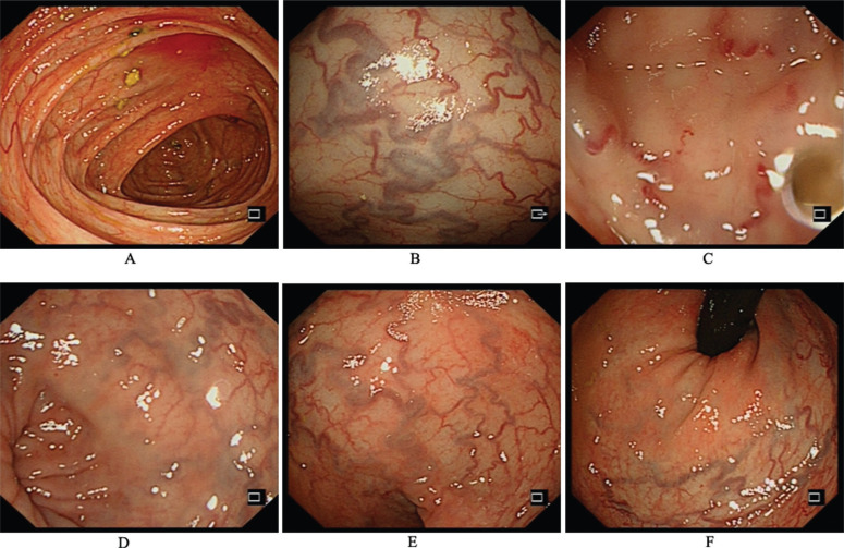DIFFUSED VASCULAR MALFORMATION OF THE ENTIRE COLON: UNUSUAL ETIOLOGY OF GASTROINTESTINAL BLEEDING IN PEDIATRICS.