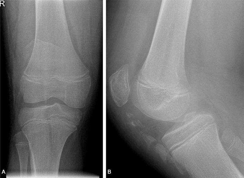 A Rare Case of Heterotopic Ossification of the Patella Tendon in an Adolescent Presenting with Tendon Rupture.