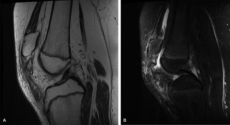 A Rare Case of Heterotopic Ossification of the Patella Tendon in an Adolescent Presenting with Tendon Rupture.