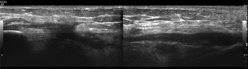 A Rare Case of Heterotopic Ossification of the Patella Tendon in an Adolescent Presenting with Tendon Rupture.