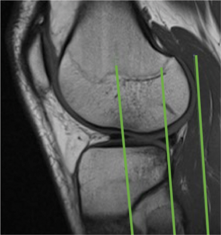 The Role of the Posterolateral Tibial Slope in the Rotational Instability of the Knee in Patients Affected by a Complete Isolated Anterior Cruciate Ligament Injury: Its Value in the Decision-Making Process during the Anterolateral Ligament Reconstruction.