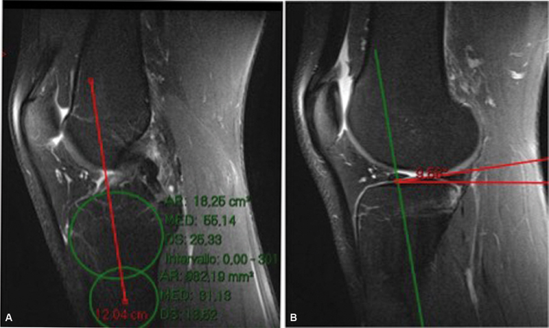 The Role of the Posterolateral Tibial Slope in the Rotational Instability of the Knee in Patients Affected by a Complete Isolated Anterior Cruciate Ligament Injury: Its Value in the Decision-Making Process during the Anterolateral Ligament Reconstruction.