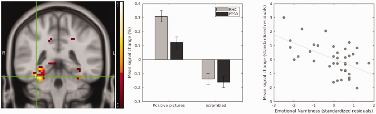 Processing of Positive Visual Stimuli Before and After Symptoms Provocation in Posttraumatic Stress Disorder - A Functional Magnetic Resonance Imaging Study of Trauma-Affected Male Refugees.