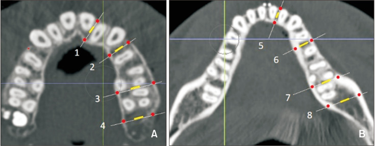 Assessment of bone density changes following two-jaw surgery using multidetector computed tomography: A pilot study.