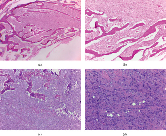 Parosteal Osteosarcoma: A Benign-Looking Tumour, Amenable to a Variety of Surgical Reconstruction.