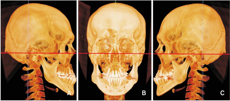 Assessment of bone density changes following two-jaw surgery using multidetector computed tomography: A pilot study.