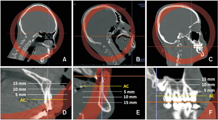 Assessment of bone density changes following two-jaw surgery using multidetector computed tomography: A pilot study.