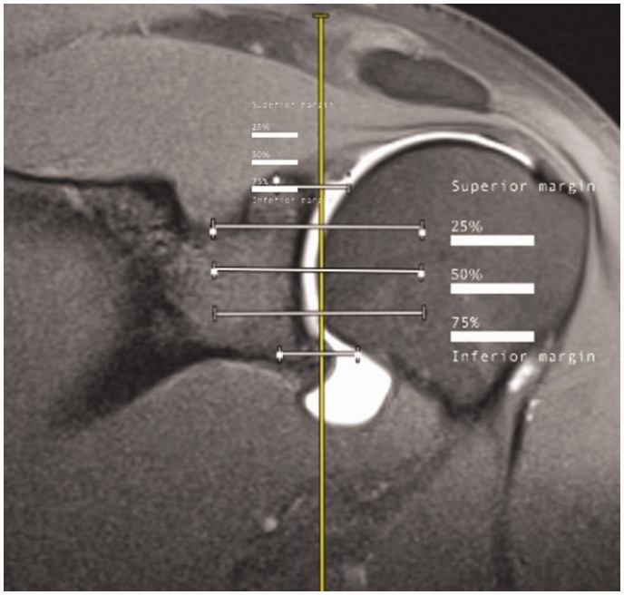 A New Method for Measuring Glenoid Version on Standard Magnetic Resonance Imaging.