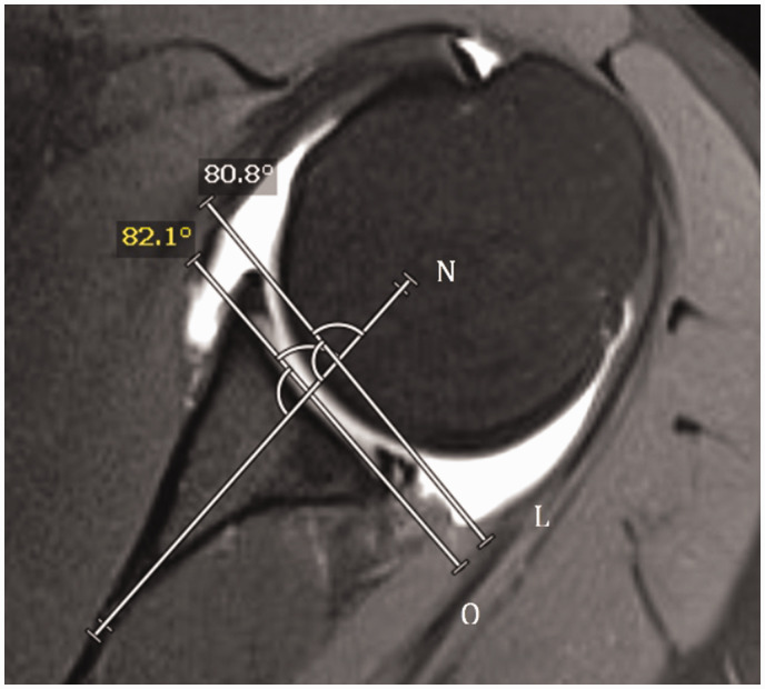 A New Method for Measuring Glenoid Version on Standard Magnetic Resonance Imaging.