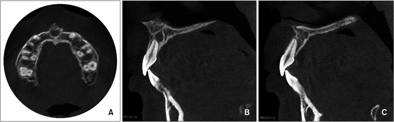 Unilateral maxillary central incisor root resorption after orthodontic treatment for Angle Class II, division 1 malocclusion with significant maxillary midline deviation: A possible correlation with root proximity to the incisive canal.