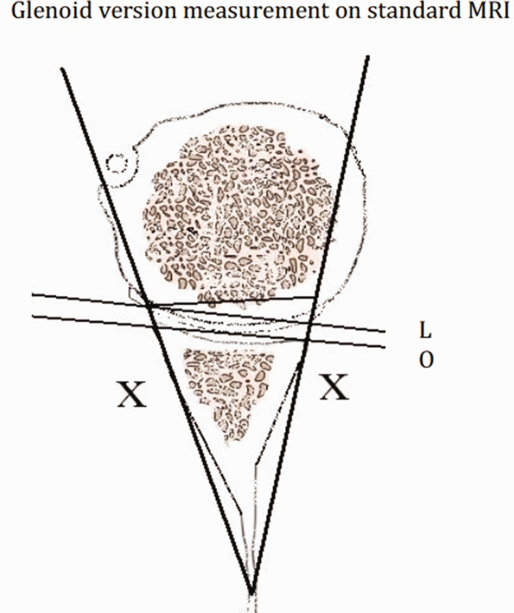 A New Method for Measuring Glenoid Version on Standard Magnetic Resonance Imaging.