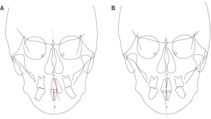 Unilateral maxillary central incisor root resorption after orthodontic treatment for Angle Class II, division 1 malocclusion with significant maxillary midline deviation: A possible correlation with root proximity to the incisive canal.