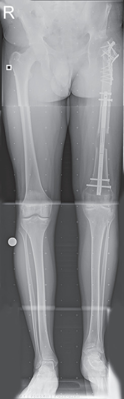 Pelvic Support Hip Reconstruction with Internal Devices: An Alternative to Ilizarov Hip Reconstruction.