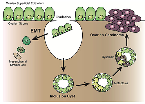 Epithelial-mesenchymal interconversions in ovarian cancer: The levels and functions of E-cadherin in intraabdominal dissemination.