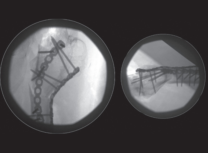 Pelvic Support Hip Reconstruction with Internal Devices: An Alternative to Ilizarov Hip Reconstruction.