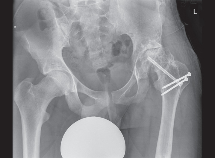 Pelvic Support Hip Reconstruction with Internal Devices: An Alternative to Ilizarov Hip Reconstruction.