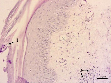 PPAR-Gamma Agonist Pioglitazone Reduced CD68+ but Not CD163+ Macrophage Dermal Infiltration in Obese Psoriatic Patients.