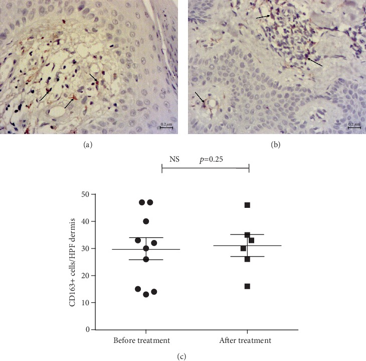 PPAR-Gamma Agonist Pioglitazone Reduced CD68+ but Not CD163+ Macrophage Dermal Infiltration in Obese Psoriatic Patients.