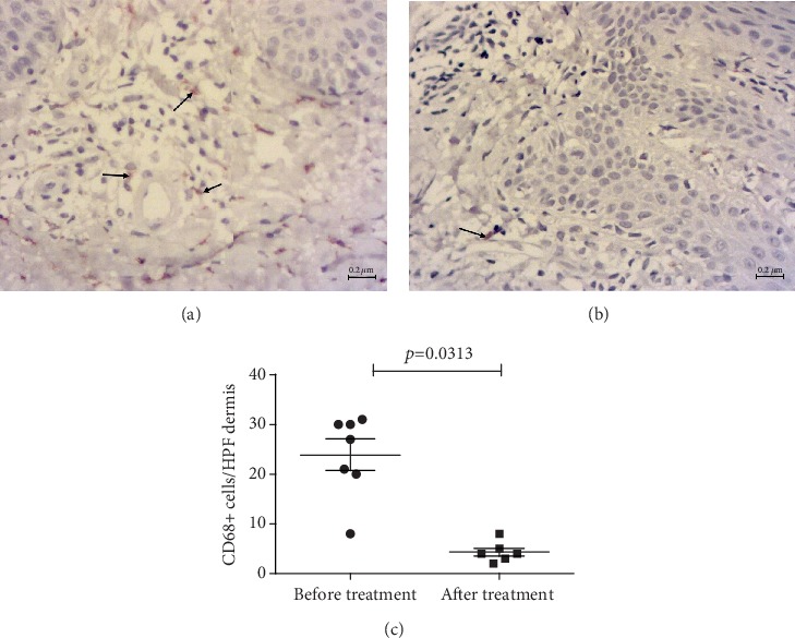 PPAR-Gamma Agonist Pioglitazone Reduced CD68+ but Not CD163+ Macrophage Dermal Infiltration in Obese Psoriatic Patients.