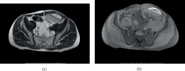 Subcapsular Renal Hematoma in Simultaneous Pancreas Kidney Transplantation.