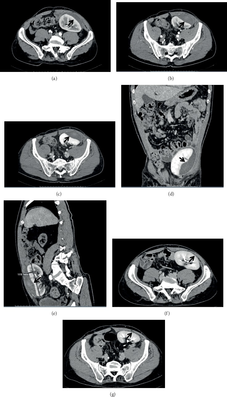 Subcapsular Renal Hematoma in Simultaneous Pancreas Kidney Transplantation.