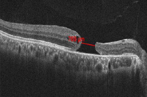 Inverted temporal internal limiting membrane flap technique for chronic large traumatic macular hole.