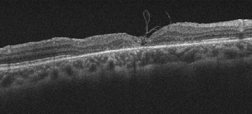 Inverted temporal internal limiting membrane flap technique for chronic large traumatic macular hole.