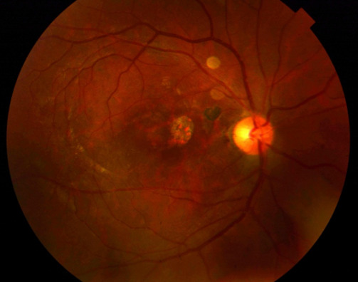 Inverted temporal internal limiting membrane flap technique for chronic large traumatic macular hole.