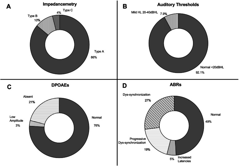 Vestibular impact of Friedreich ataxia in early onset patients.