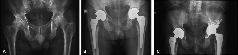 A Mid- to Long-Term Follow-Up Experience with a Specific Metal-on-Metal Total Hip Arthroplasty Design.