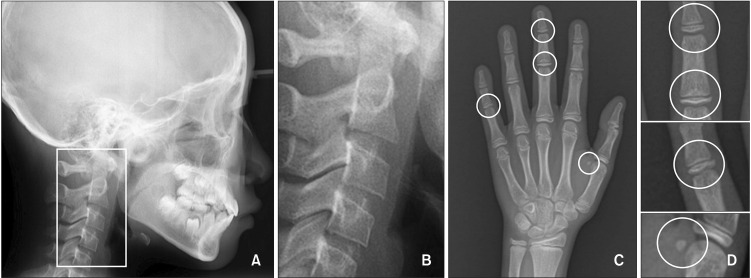 Evaluation of cephalometric characteristics and skeletal maturation of the cervical vertebrae and hand-wrist in girls with central precocious puberty.