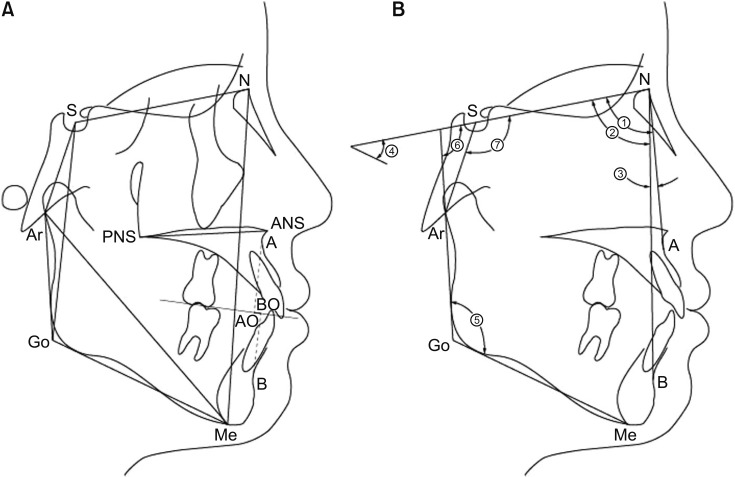 Evaluation of cephalometric characteristics and skeletal maturation of the cervical vertebrae and hand-wrist in girls with central precocious puberty.