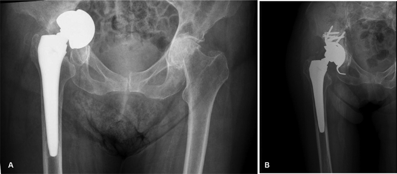 A Mid- to Long-Term Follow-Up Experience with a Specific Metal-on-Metal Total Hip Arthroplasty Design.