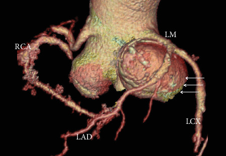 Unruptured Multiple Sinus of Valsalva Aneurysms.