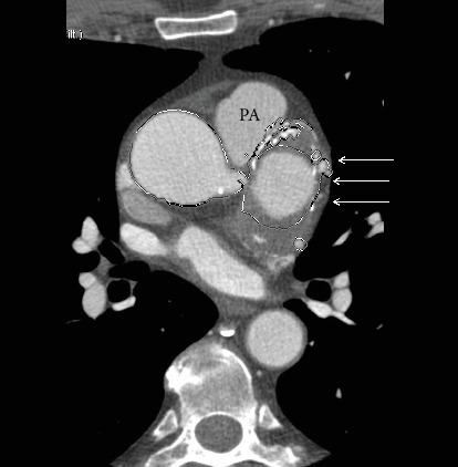 Unruptured Multiple Sinus of Valsalva Aneurysms.