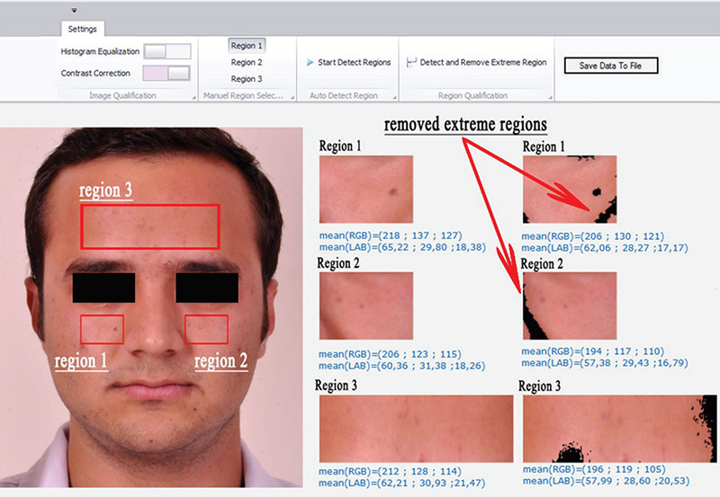 Use of a new skin colour measurement method for the investigation of relationship between skin and tooth colour.