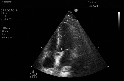 Cardiopulmonary Ultrasonography for Severe Coronavirus Disease 2019 Patients in Prone Position.