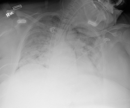 Cardiopulmonary Ultrasonography for Severe Coronavirus Disease 2019 Patients in Prone Position.