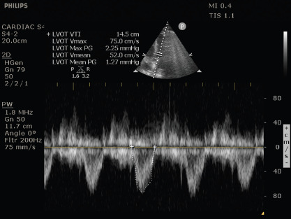 Cardiopulmonary Ultrasonography for Severe Coronavirus Disease 2019 Patients in Prone Position.