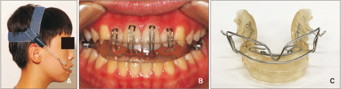 Evaluation of growth changes induced by functional appliances in children with Class II malocclusion: Superimposition of lateral cephalograms on stable structures.