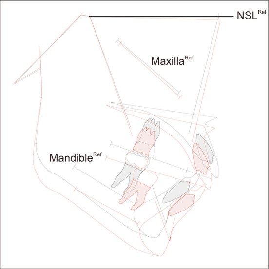 Evaluation of growth changes induced by functional appliances in children with Class II malocclusion: Superimposition of lateral cephalograms on stable structures.