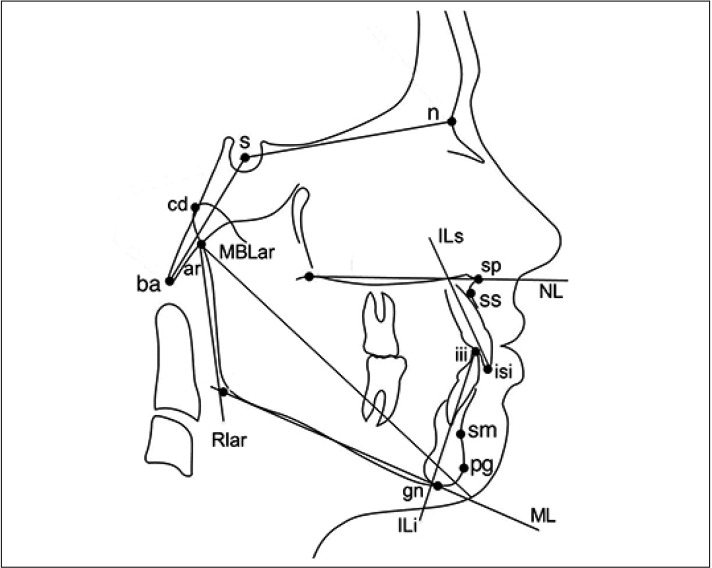 Evaluation of growth changes induced by functional appliances in children with Class II malocclusion: Superimposition of lateral cephalograms on stable structures.