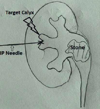 Percutaneous Nephrolithotomy: Challenges for a Novice Urologist.