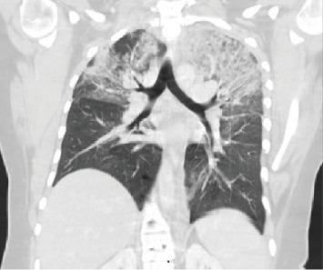 E-Cigarette- and Vaping-Related Lung Injury (EVALI) at a Regional Hospital System in South Carolina.