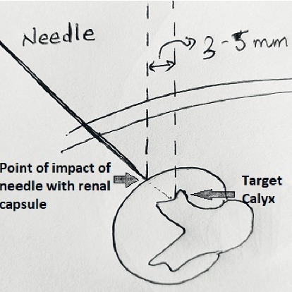 Percutaneous Nephrolithotomy: Challenges for a Novice Urologist.