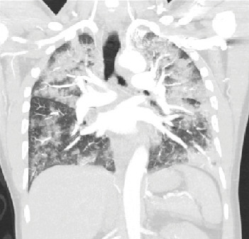 E-Cigarette- and Vaping-Related Lung Injury (EVALI) at a Regional Hospital System in South Carolina.